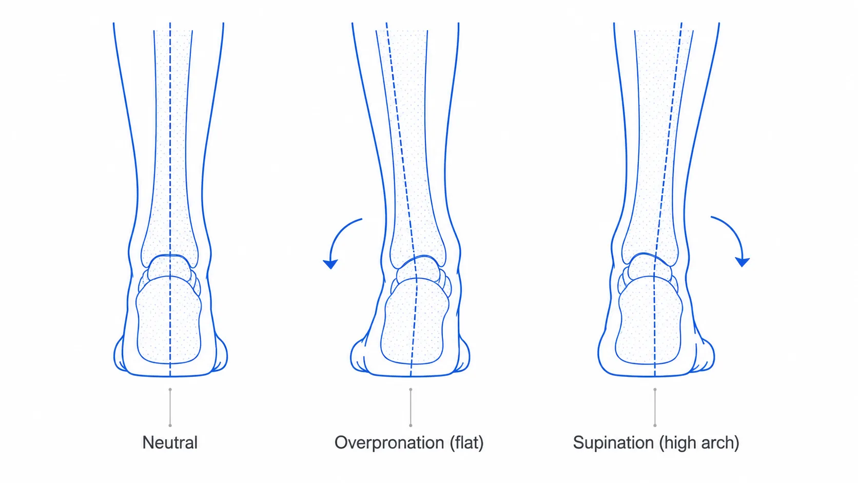 Three rear-view feet showing neutral, overpronation (inward roll) and supination (outward roll) running patterns